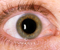 Diabetic retinopathy and the role of the general practitioners
